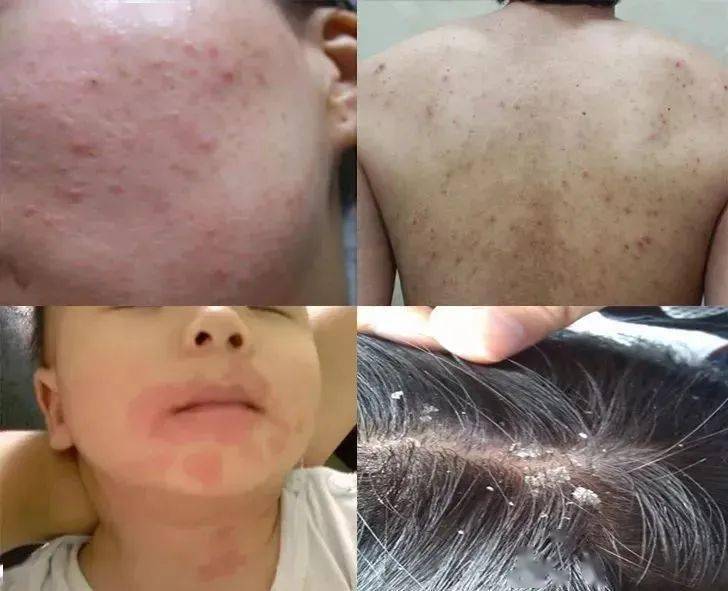 用什么泡水喝可以消除淋巴结 4289e3424a074fa4b7523faa769b5179.jpeg