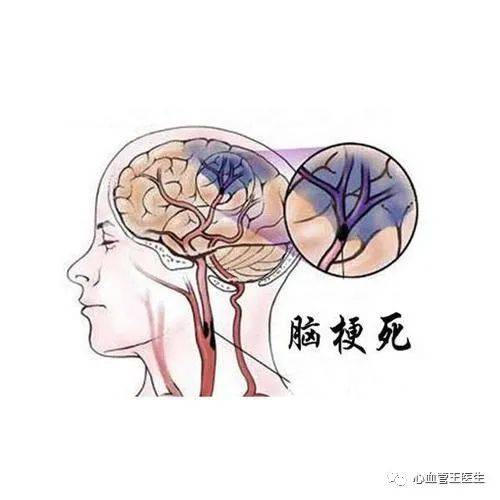 治疗|吃着阿司匹林和他汀二次脑梗？医生辟谣：不同脑梗服药不同！