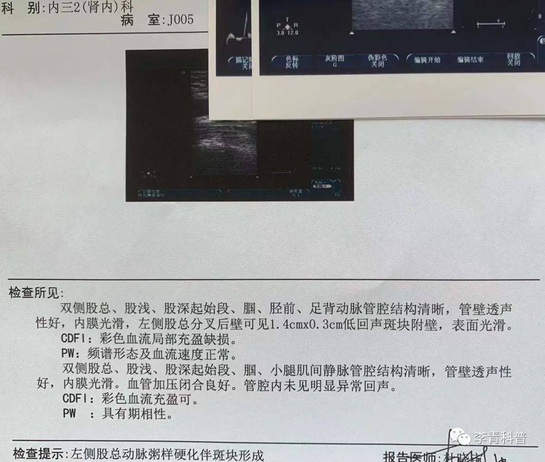 治疗|43岁严重糖尿病肾病、眼底出血,他的错误许多人还在重复!