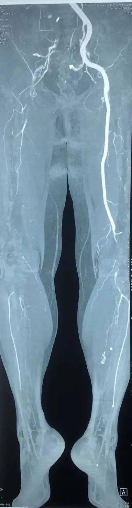 冠状动脉|广州64岁阿姨体内取出一米长的血栓！专家教你绕开这些“梗”……