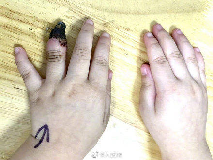 无名指|3岁女童因错误包扎手指被截