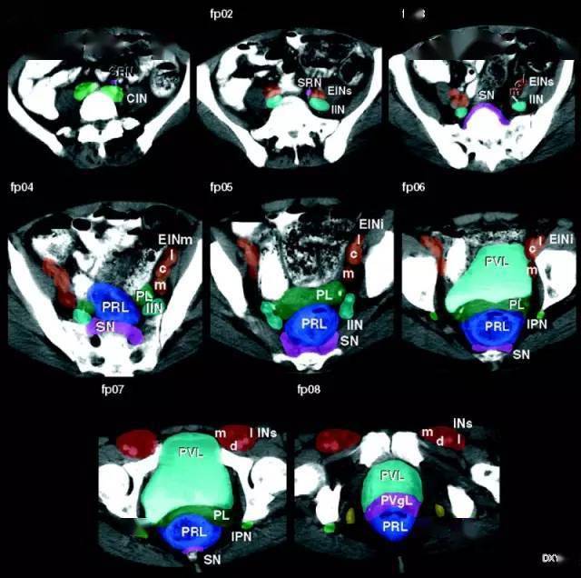 女性盆腔定位 ct 像