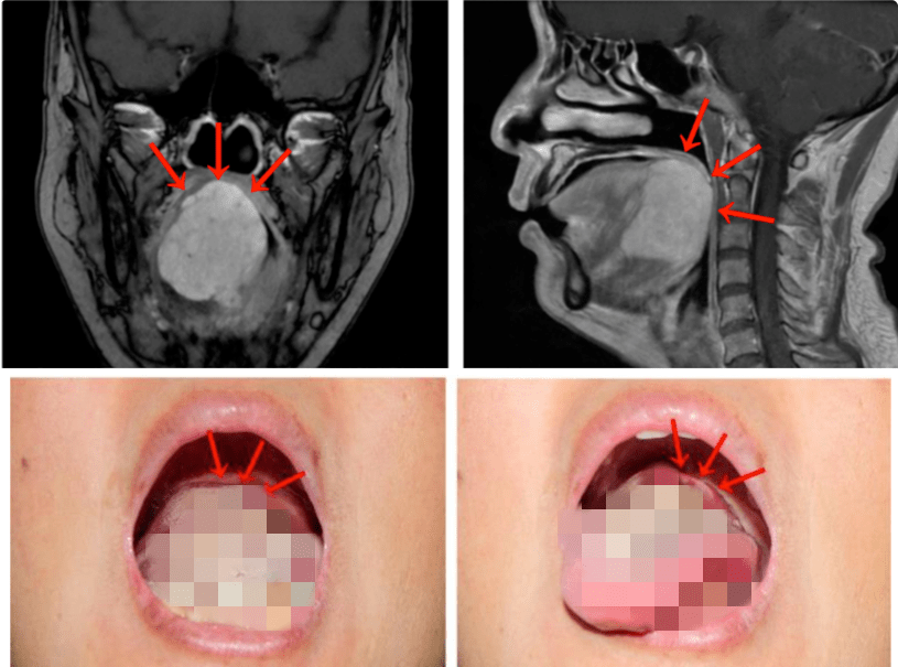 宋明|广州一女子做核酸检测，意外发现患癌！