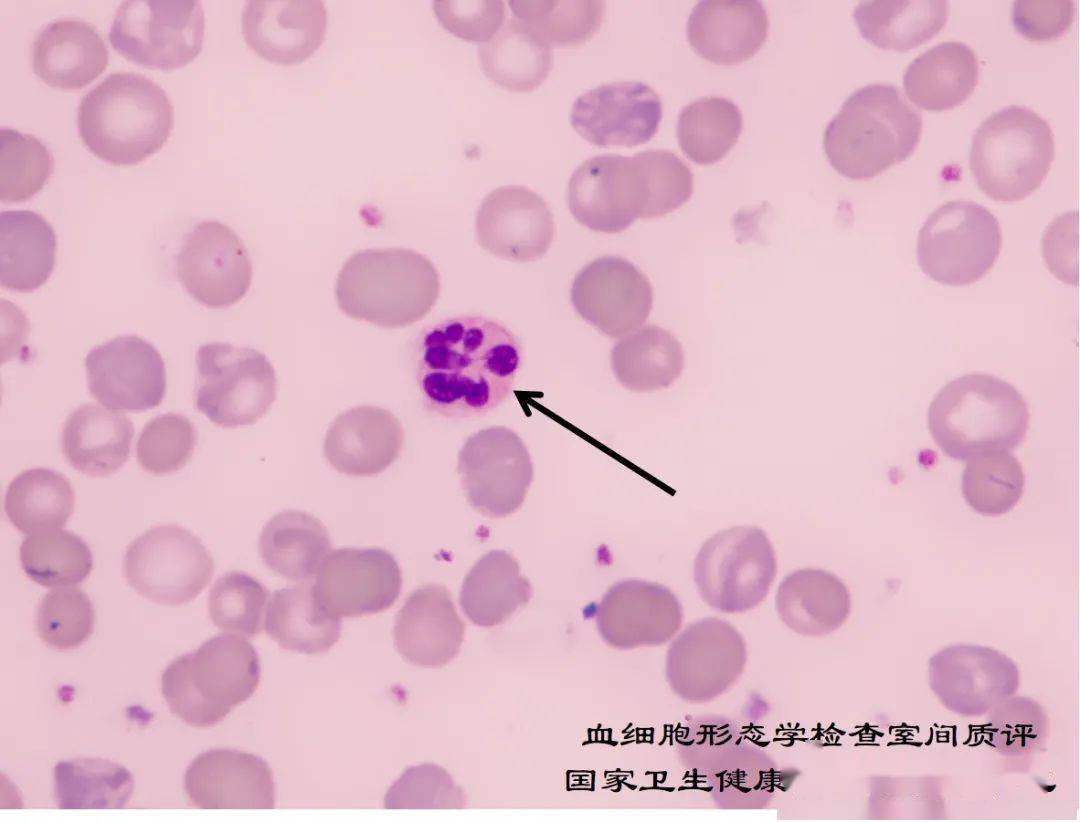 红细胞皱缩图片图片