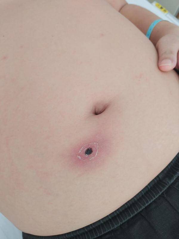 检查|当心！此地2人高烧不退，核酸阴性！医生发现“元凶”