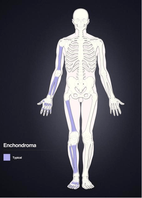 程序员手疼7年查出骨肿瘤是长期敲键盘惹的祸吗