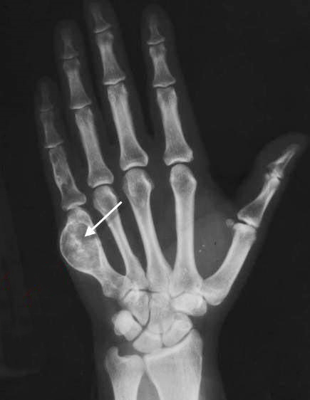 程序员手疼7年查出骨肿瘤是长期敲键盘惹的祸吗