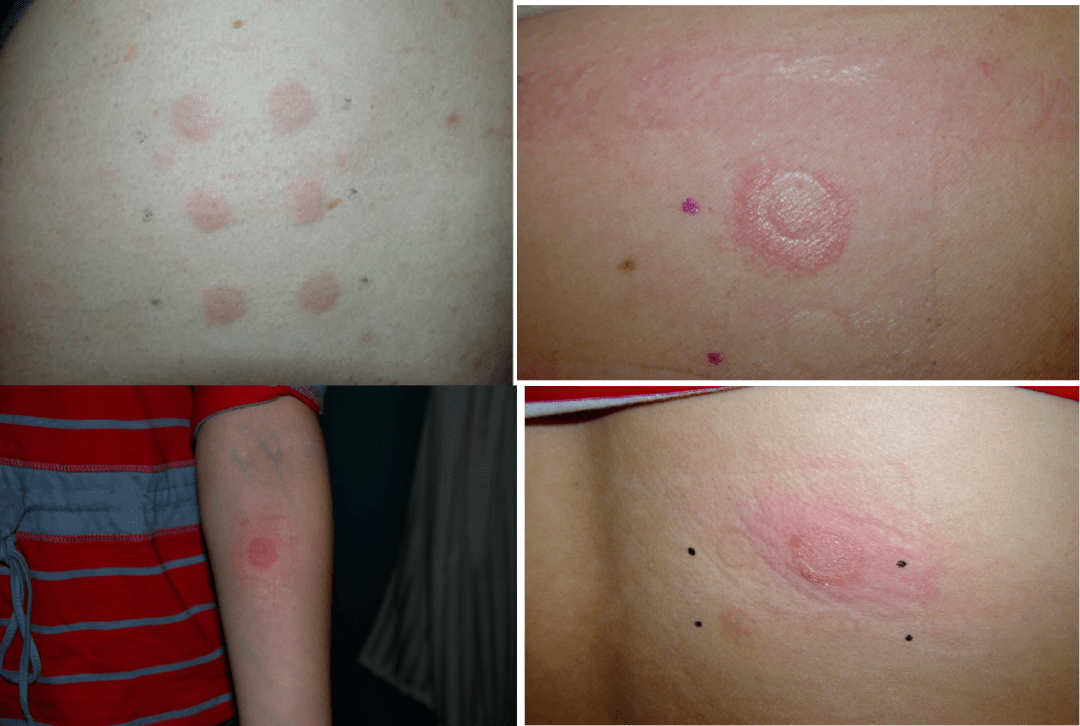 怕用了化妆品过敏爱美人士不妨查查斑贴试验