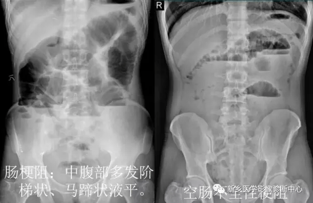 弹簧|图解21种腹部疼痛原因