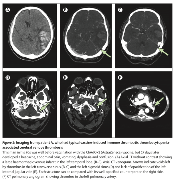 特征|《柳叶刀》：英国新冠疫苗接种后罕见脑静脉血栓特征及其治疗
