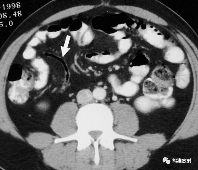 看图学病丨阑尾炎appendicitis