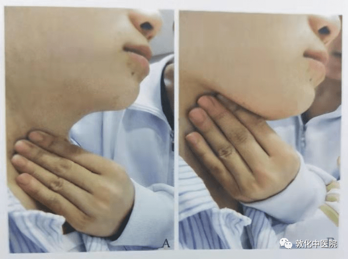 脑卒中吞咽障碍的康复训练