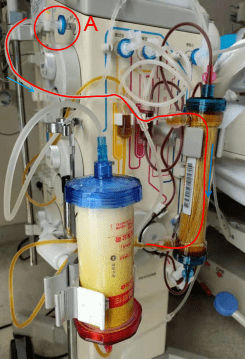 双重血浆分子吸附操作流程和实战交流