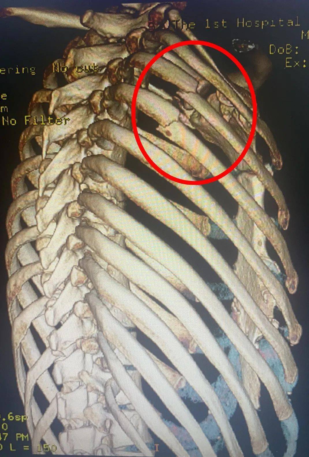 胸部ct提示:右肩胛骨粉碎性骨折 右侧第3,4肋骨骨折