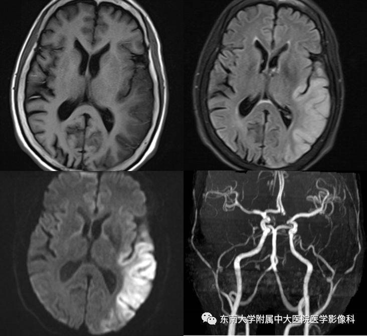 影像易誤診為腦卒中部分少見病例分析_解剖圖