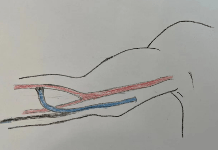 进行|【医患一家】精益求精,迎难而上,肾内科为血液透析患者重建“生命线”