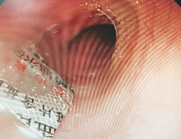 老人|糟心，男子吃药时接了一通电话，直接带包装吞了下去