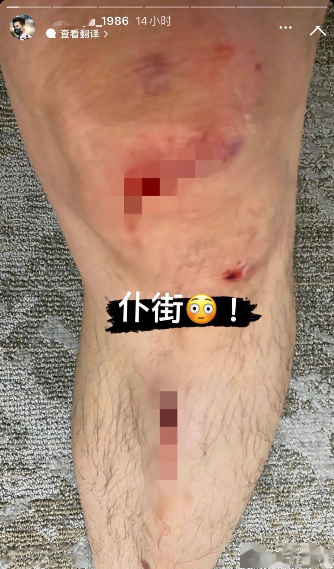 从车上摔下血流不止,深夜被紧急送往医院_伤口