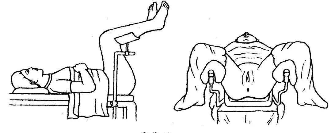 妇科膀胱截石位图图片
