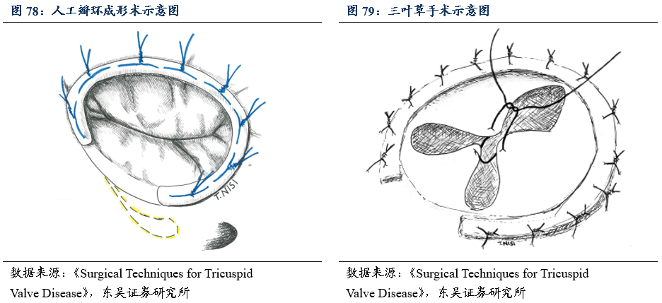 三尖瓣成形术图片