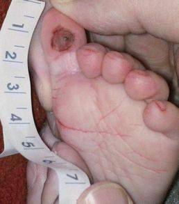 右耳深部组织损伤图4:气管插管固定板造成的婴儿颈部不可分期压疮图3