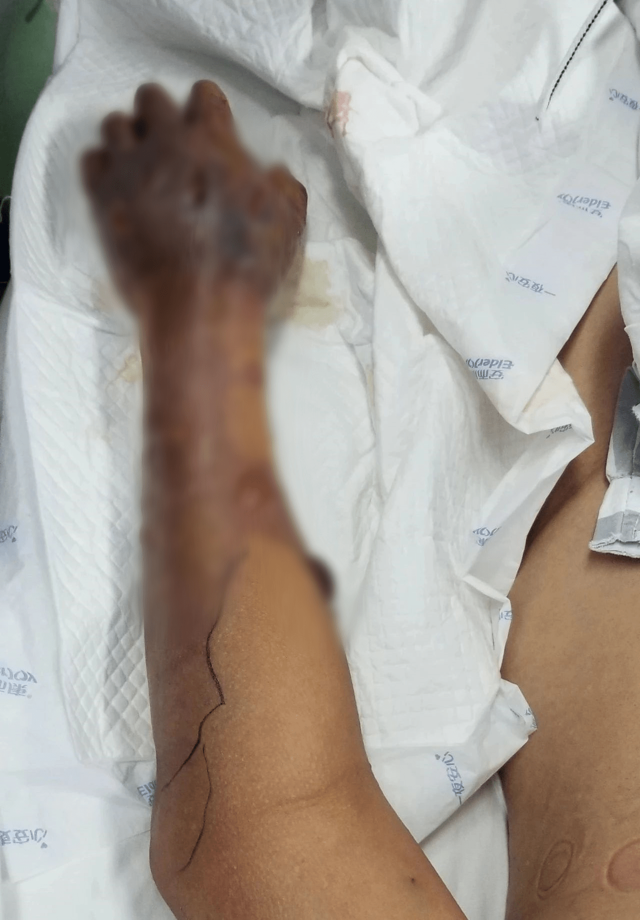 男子洗鱼后手上全是大水泡医生立即截肢保命