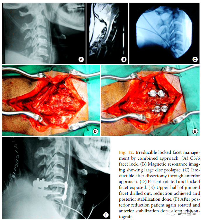 acdf(f)頸椎創傷後椎動脈損傷頸椎創傷後椎動脈損傷(vertebral artery