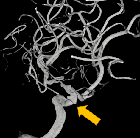 dsa 3d成像顯示為顱內串聯多發動脈瘤及左側大腦中動脈m1段起始部重度