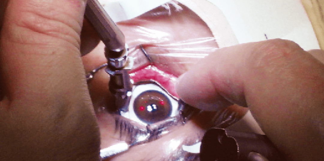 教你一步步操作准分子激光原位角膜磨镶术