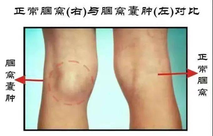 将腘窝囊肿切除患者可通过关节镜微创手术骨科三病区副主任医生邢林卿