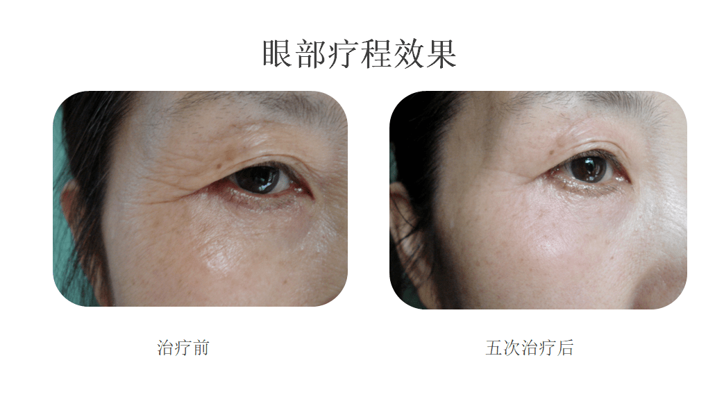 怎么去眼角细纹和法令纹 e1055cfc80fb40fab86b091d739f6436.png