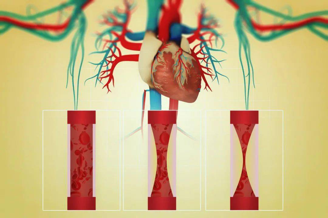 危害|颈动脉斑块需认真对待