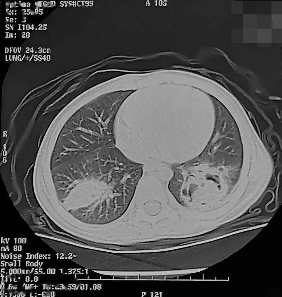 【首儿医典】小儿肺炎_小安