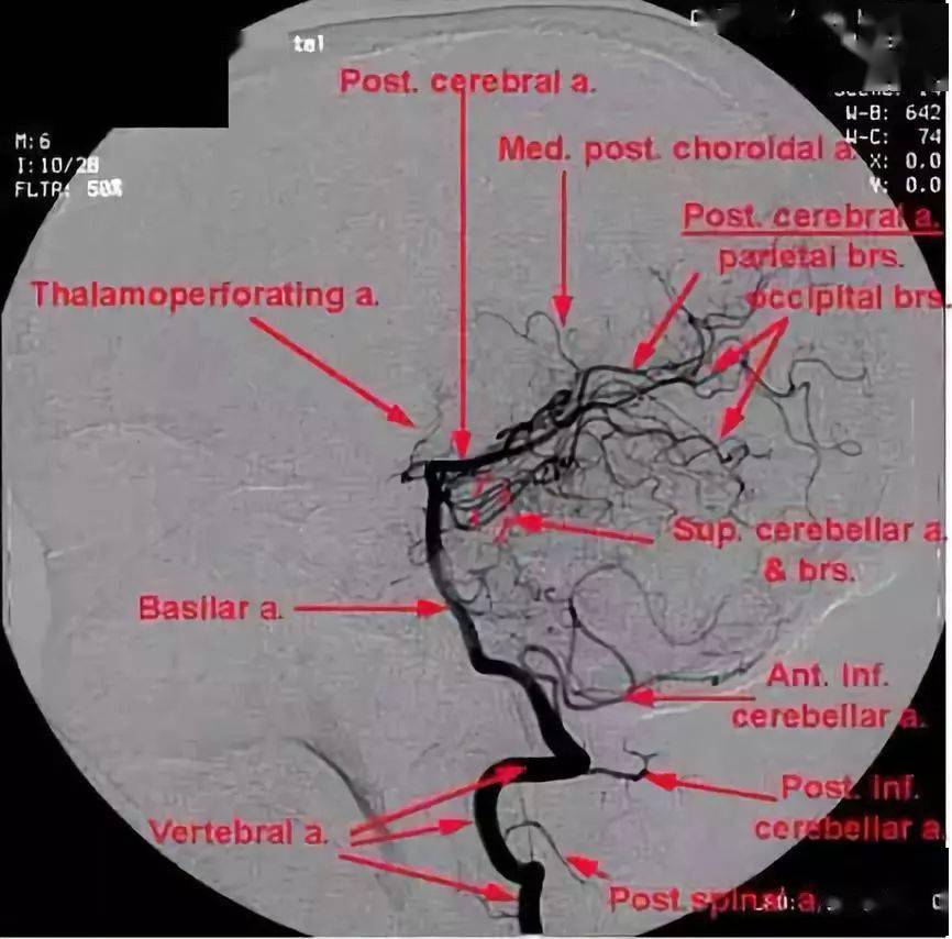 脑血管 dsa 不会看?这篇文章带你入门_动脉