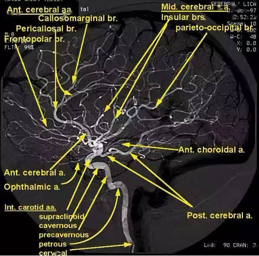 脑血管 dsa 不会看?这篇文章带你入门_动脉