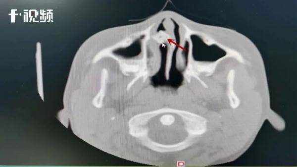 检查|家长警惕！九岁男童鼻腔内取出麻将色子，异物周围长满肉芽