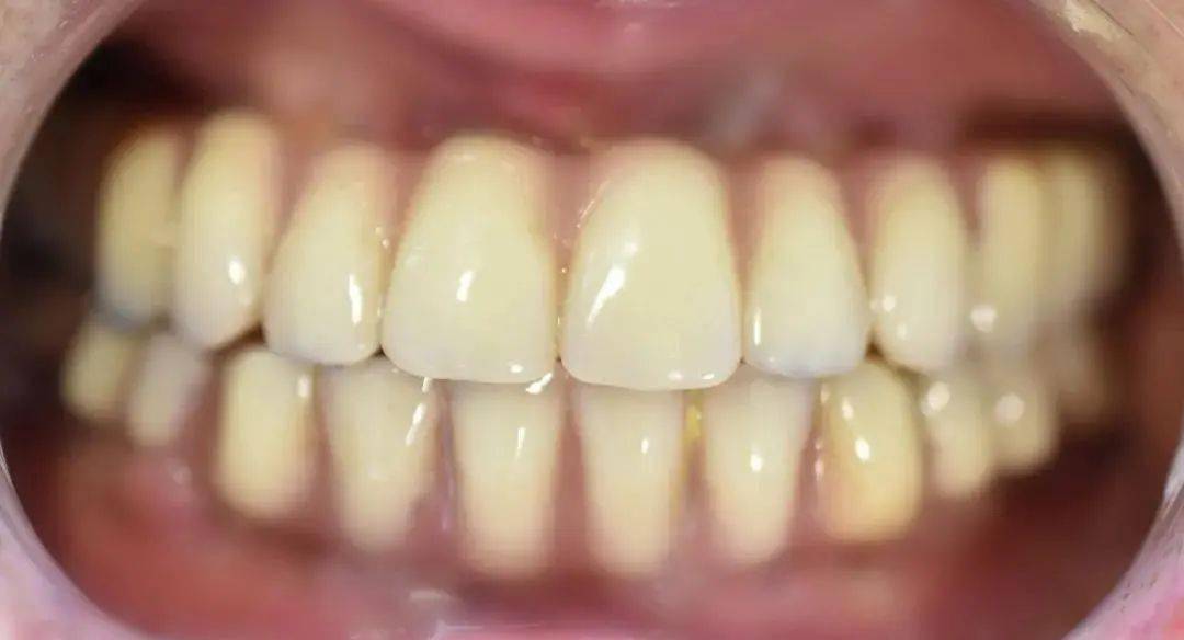 福利|种植牙大咖面对面+超强福利，机不可失，11—12日能省一大笔钱！！！