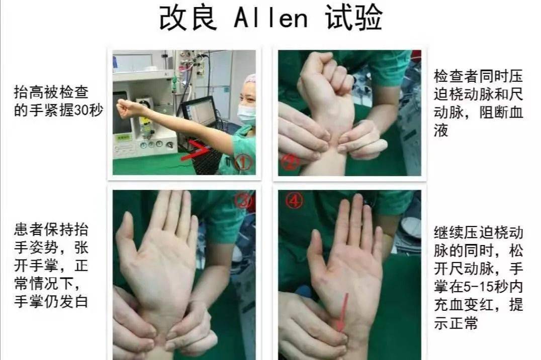 掌握allens试验或改良allens试验 改良allens试验,即改良艾伦试验