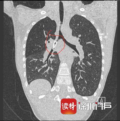 笔帽|惊险！10岁男孩跌倒，把笔帽吞了下去…