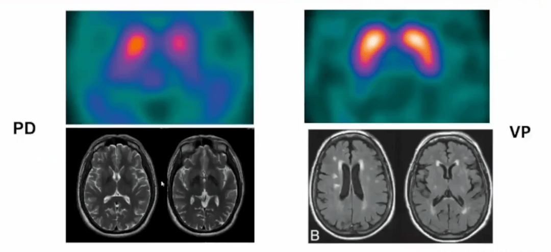 诊断|血管性帕金森综合征诊疗共识，执笔者亲身解读，不容错过！
