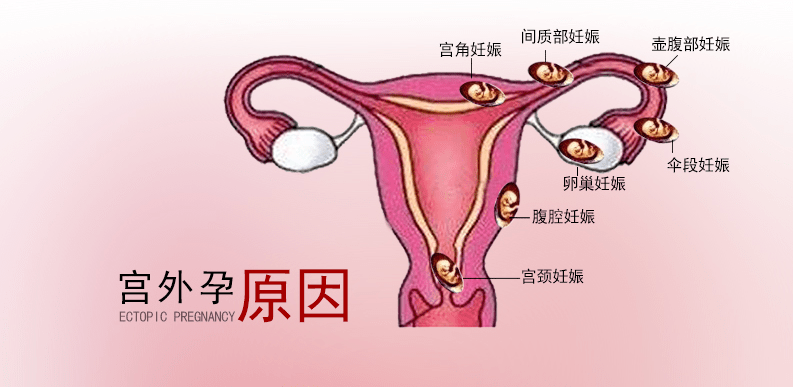 宫角妊娠的位置图片图片