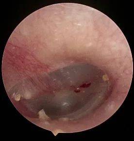 蟑螂|夜半惊魂！小伙正睡着觉，耳朵里钻进一只…医生将其“憋死”后取出