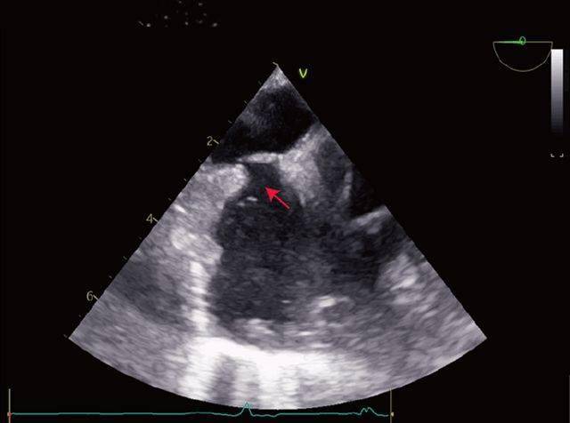 食管中段切面:左房,左室内大量气泡床旁行腹部超声及经食道超声心动图