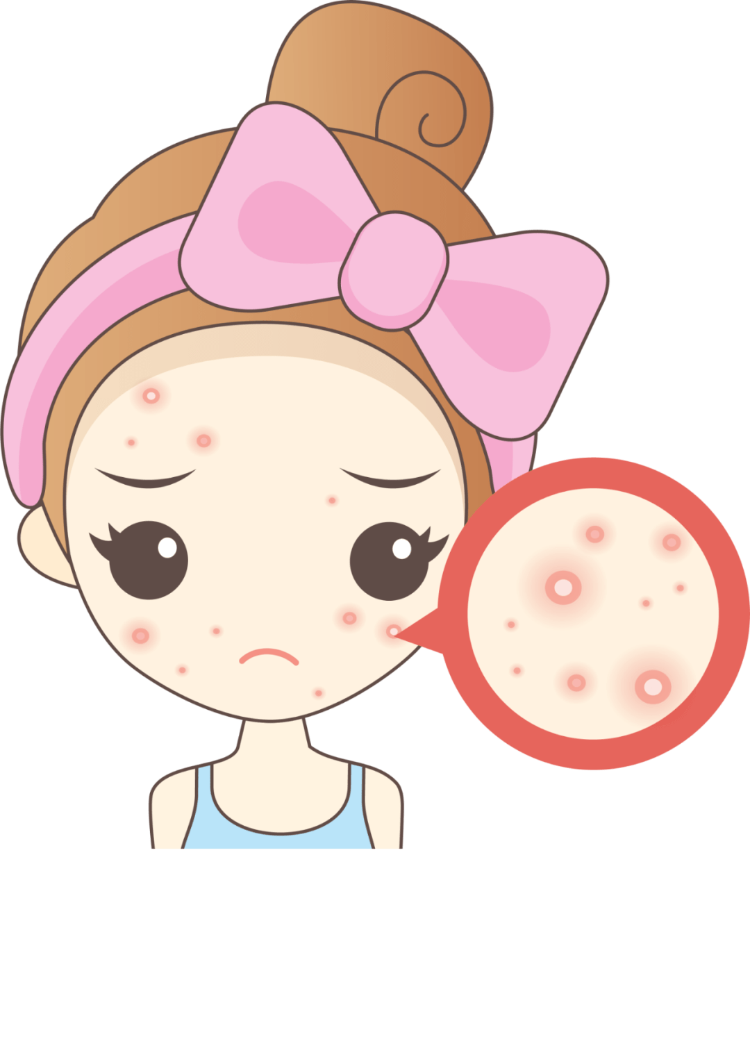 痤疮,多是青春期男女常见皮肤病,主要表现为红色丘疹,脓疱,结节,囊肿