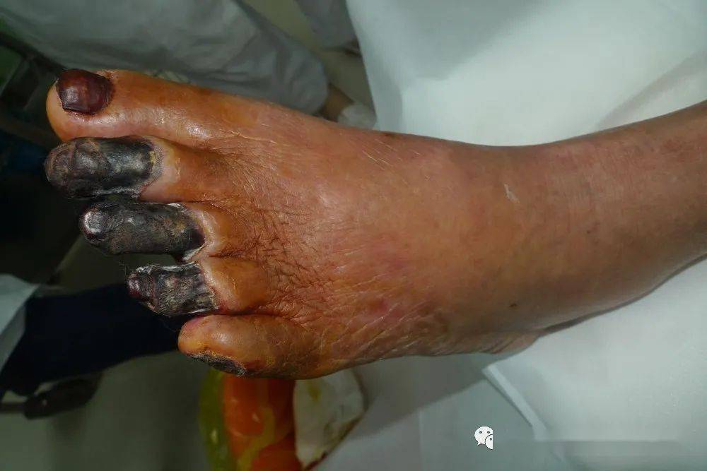 一例足趾发黑坏疽的糖尿病足治疗