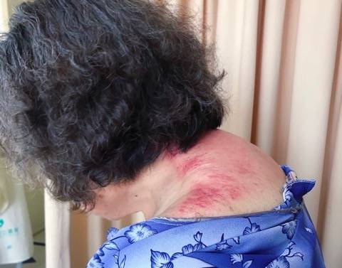 长沙80岁"重度网瘾奶奶"沉迷玩手机,长了恼人的"富贵包"_症状