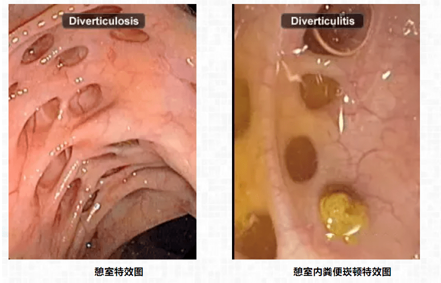 肠子流出哗啦图片