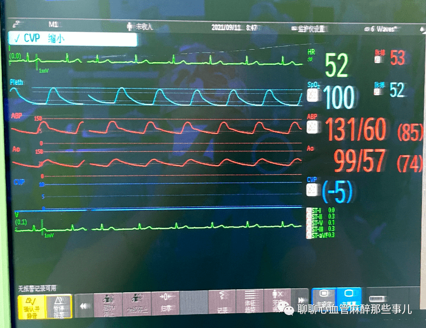 为了证实该问题,先用袖带进行右侧无创血压监测,测得血压明显增高.