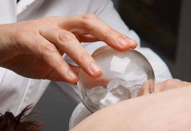 注意起罐手法起罐时,手法宜轻缓,以一手指抵住罐口边缘的肌肉,按压一