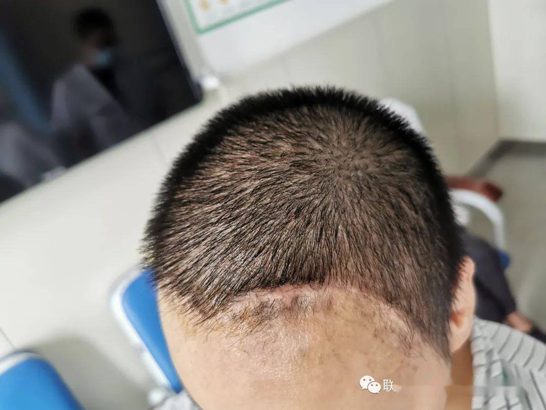 重型颅脑损伤患者命悬一线部队医院高效救治挽回生命